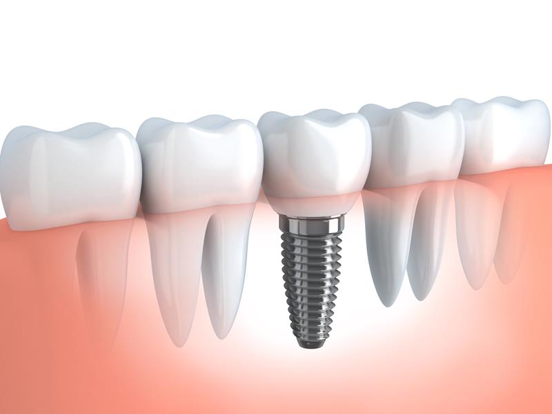 Dental Implants Bellevue, WA
