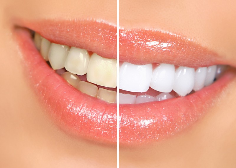 Teeth Whitening Bellevue, WA